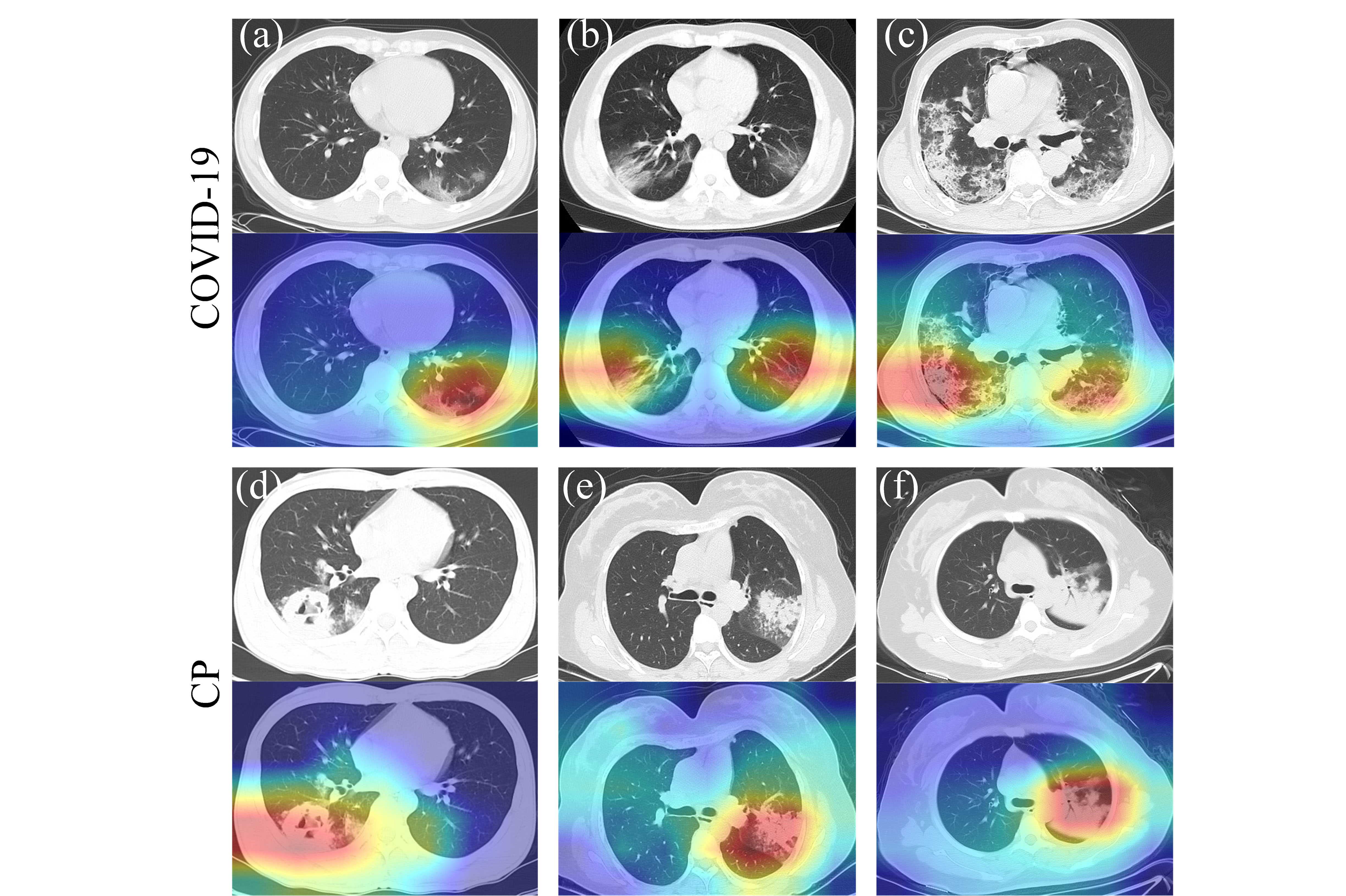 UM develops intelligent system to quickly tell COVID19caused pneumonia from regular pneumonia